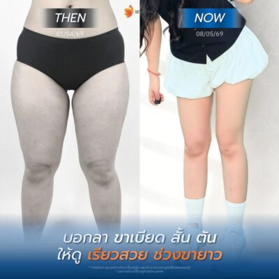 รีวิวต้นขา คุณแพทตี้ การเตรียมตัวก่อนดูดไขมันมัน