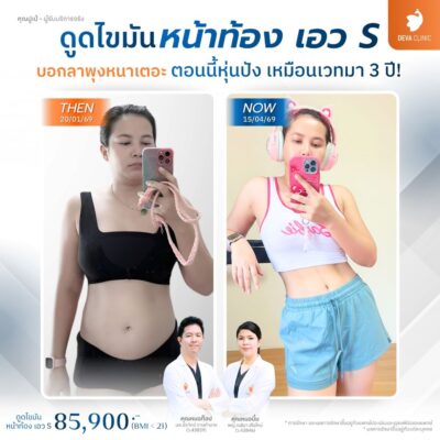 รีวิวก่อนหลัง หน้าท้อง คุณปูเป้