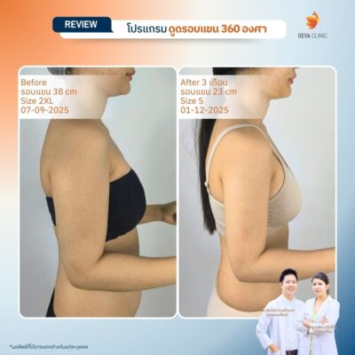 รีวิวดูดไขมันต้นแขน แก้แขนใหญ่ 3