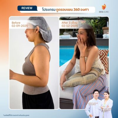 รีวิวดูดไขมันต้นแขนสาวตัวเล็ก แต่แขนใหญ่ (Skinny Fat) 7