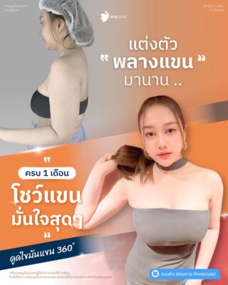 รีวิวต้นแขนใหญ่กรรมพันธุ์ คุณจอย