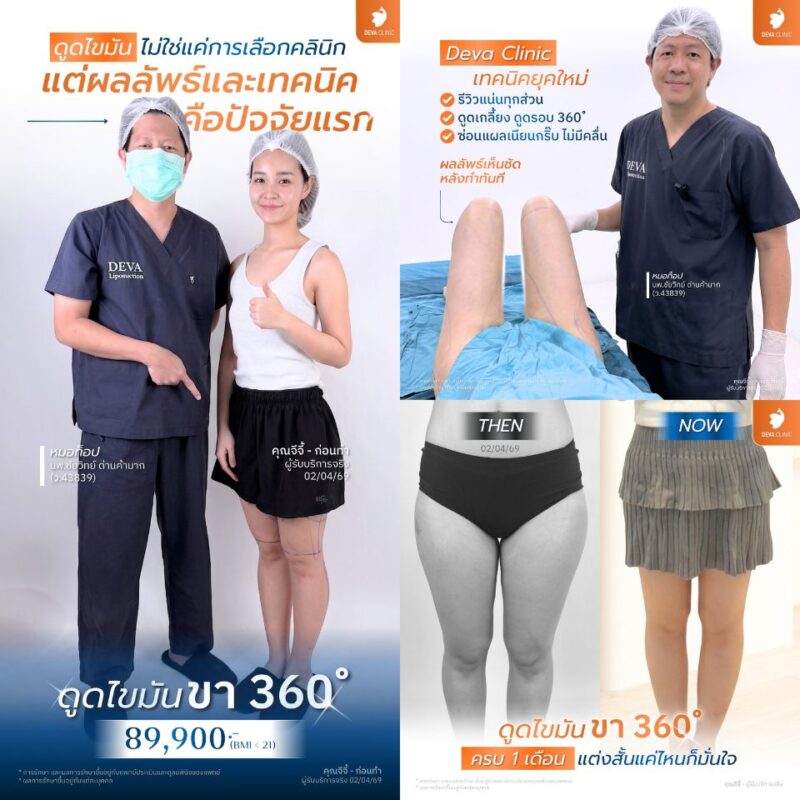 4 บริเวณยอดฮิตในการผ่าตัดไขมันส่วนเกิน ต้นขา