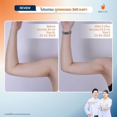 รีวิว แขนย้วย หลังดูดไขมัน ไม่ทำกระชับผิว J plasma 5