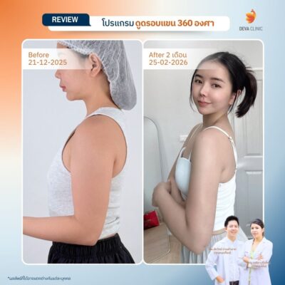 รีวิวดูดไขมันต้นแขนสาวตัวเล็ก แต่แขนใหญ่ (Skinny Fat) 11