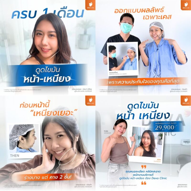 4 บริเวณยอดฮิตในการผ่าตัดไขมันส่วนเกิน กรอบหน้า เหนียง