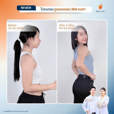 รีวิวดูดไขมันต้นแขนสาวตัวเล็ก แต่แขนใหญ่ (Skinny Fat) 12