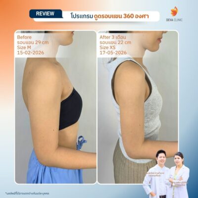 รีวิวดูดไขมันต้นแขนสาวตัวเล็ก แต่แขนใหญ่ (Skinny Fat) 13