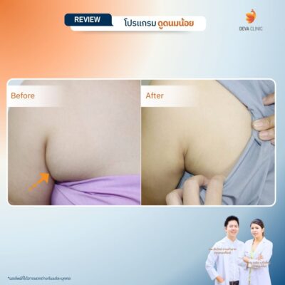 รีวิว-ดูดไขมันนมน้อย 3