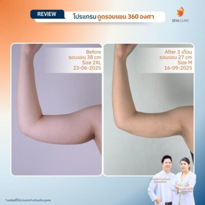 รีวิวดูดไขมันแขน เคสจริงจาก Deva Clinic แขนเรียวกระชับ แผลเล็ก เจ็บน้อย 3