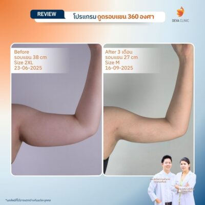 รีวิวดูดไขมันแขน เคสจริงจาก Deva Clinic แขนเรียวกระชับ แผลเล็ก เจ็บน้อย 6