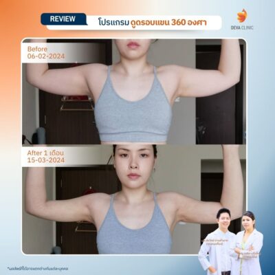 รีวิวดูดไขมันแขน เคสจริงจาก Deva Clinic แขนเรียวกระชับ แผลเล็ก เจ็บน้อย 8