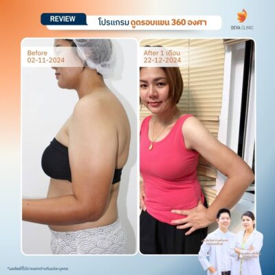 รีวิวดูดไขมันแขน เคสจริงจาก Deva Clinic แขนเรียวกระชับ แผลเล็ก เจ็บน้อย 15
