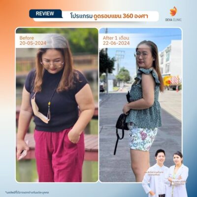 รีวิวดูดไขมันแขน เคสจริงจาก Deva Clinic แขนเรียวกระชับ แผลเล็ก เจ็บน้อย 16