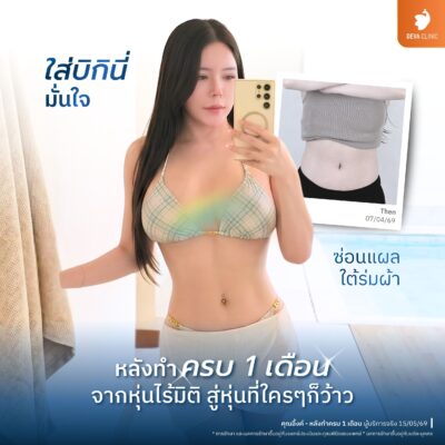 รีวิวหน้าท้อง คุณอิ้งค์