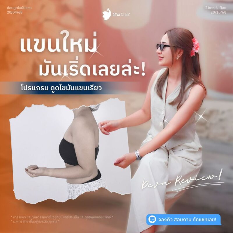 รีวิวดูดต้นแขน คุณกวาง