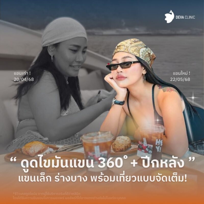 รีวิวดูดต้นแขน คุณคุณ