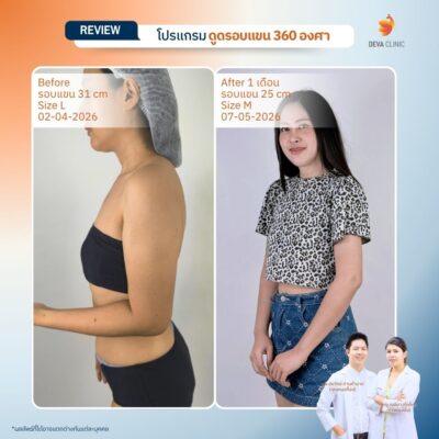 รีวิวดูดไขมันต้นแขนสาวตัวเล็ก แต่แขนใหญ่ (Skinny Fat) 15