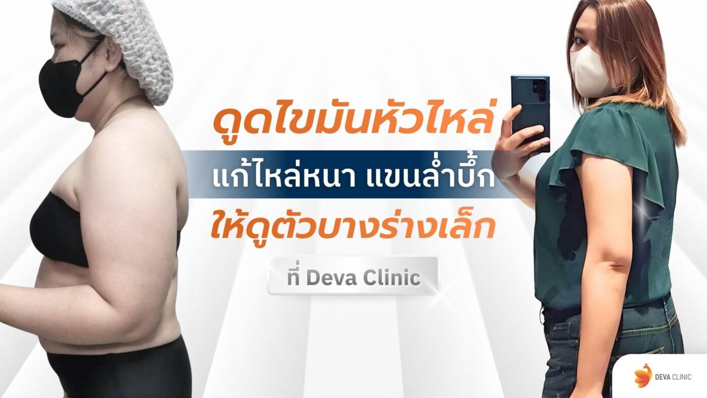 ดูดไขมันหัวไหล่