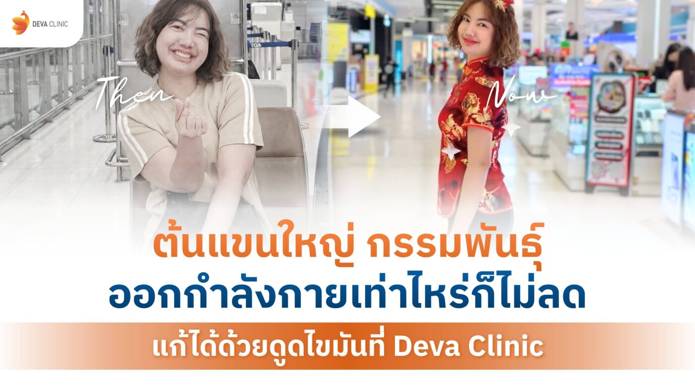 ต้นแขนใหญ่ กรรมพันธุ์