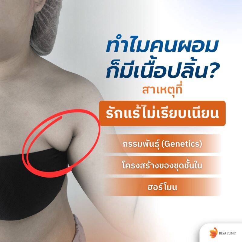 ทำไมคนผอมก็มีเนื้อปลิ้นรักแร้