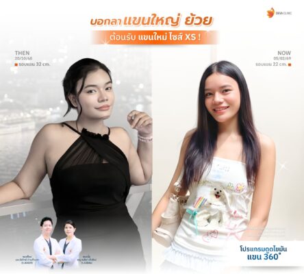 รีวิวดูดไขมันต้นแขน คุณนิ้ง หน้าดูดไขมัน