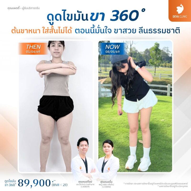 คำนวณราคาดูดไขมันต้นขา 360 องศา