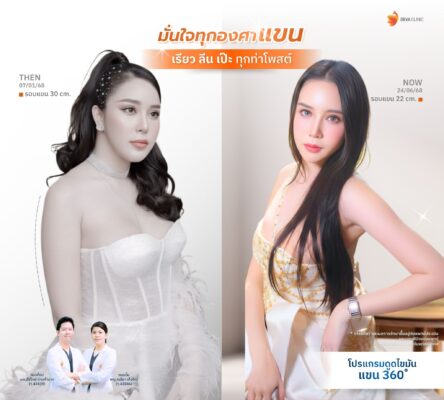 รีวิวดูดไขมันต้นแขน คุณจอย หน้าดูดไขมัน