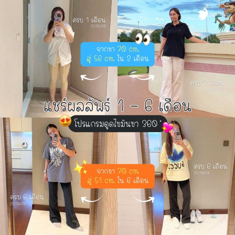 บันทึกผลลัพธ์รีวิวดูดไขมันต้นขา คุณชารีฟ