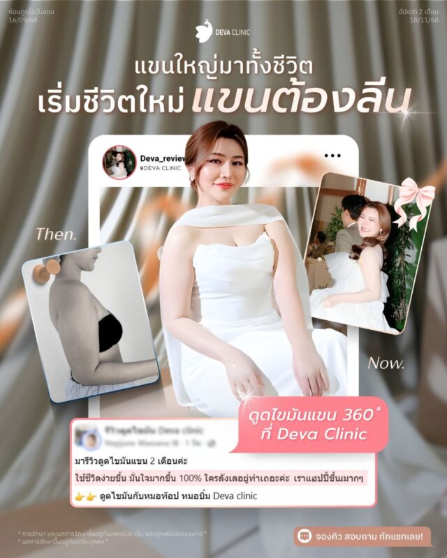 รีวิวความประทับใจ ดูดไขมันแขน บวมกี่วัน 2