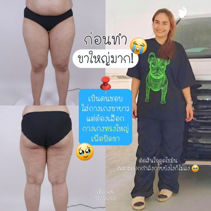ก่อนทำ คุณชารีฟ รีวิวดูดไขมันต้นขา