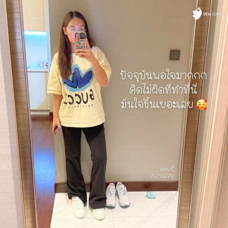 ผลลัพธ์ 6 เดือน รีวิวดูดไขมันต้นขา คุณชารีฟ