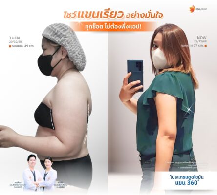 รีวิวดูดไขมันต้นแขน คุณโอปอ หน้าดูดไขมัน