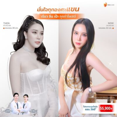 รีวิวดูดไขมันต้นแขน จอย