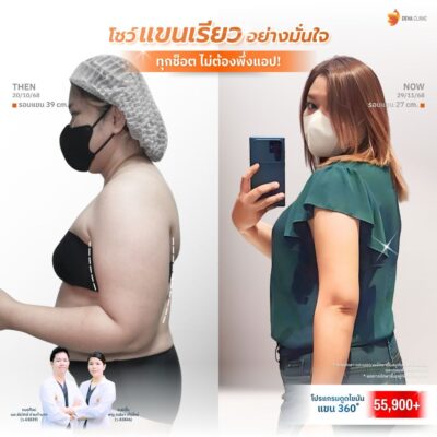 รีวิวดูดไขมันต้นแขน โอปอ
