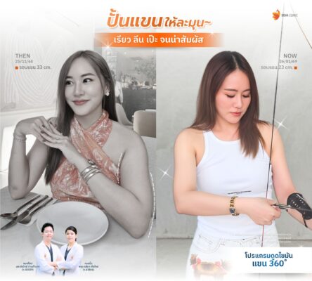 รีวิวดูดไขมันต้นแขน คุณจีจี้หน้าดูดไขมัน