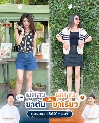 รีวิวขาเบียด ดูดไขมันต้นขา 3