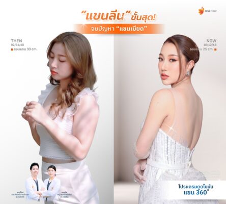 รีวิวดูดไขมันต้นแขน คุณหนิง หน้าดูดไขมัน