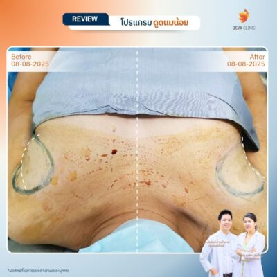 รีวิวดูดไขมันรักแร้ 8