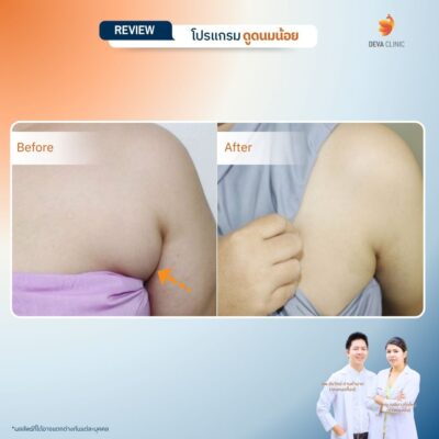 รีวิวดูดไขมันรักแร้ 9