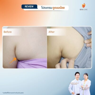 รีวิวดูดไขมันรักแร้ 10