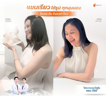 รีวิวดูดไขมันต้นแขน คุณไกด์ หน้าดูดไขมัน