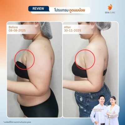 รีวิวดูดไขมันรักแร้ 2