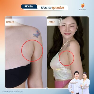 รีวิวดูดไขมันรักแร้ 3