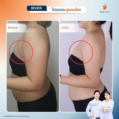 รีวิวดูดไขมันรักแร้ 4