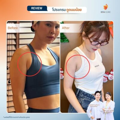 รีวิวดูดไขมันรักแร้ 5