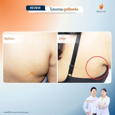 รีวิวดูดไขมันปีกหลัง 2