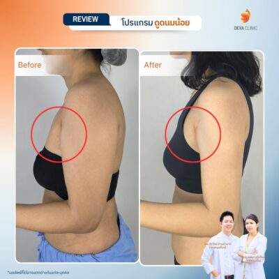 รีวิวดูดไขมันรักแร้ 6