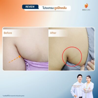 รีวิวดูดไขมันปีกหลัง 1