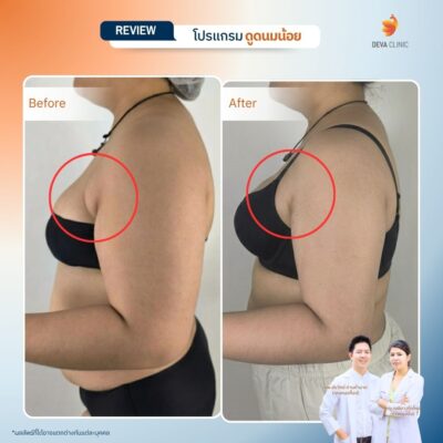 รีวิวดูดไขมันรักแร้ 7