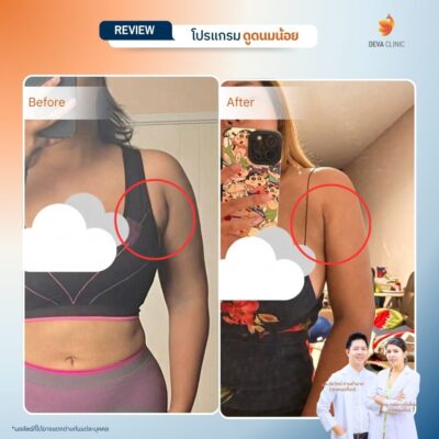 รีวิวดูดไขมันรักแร้ 1